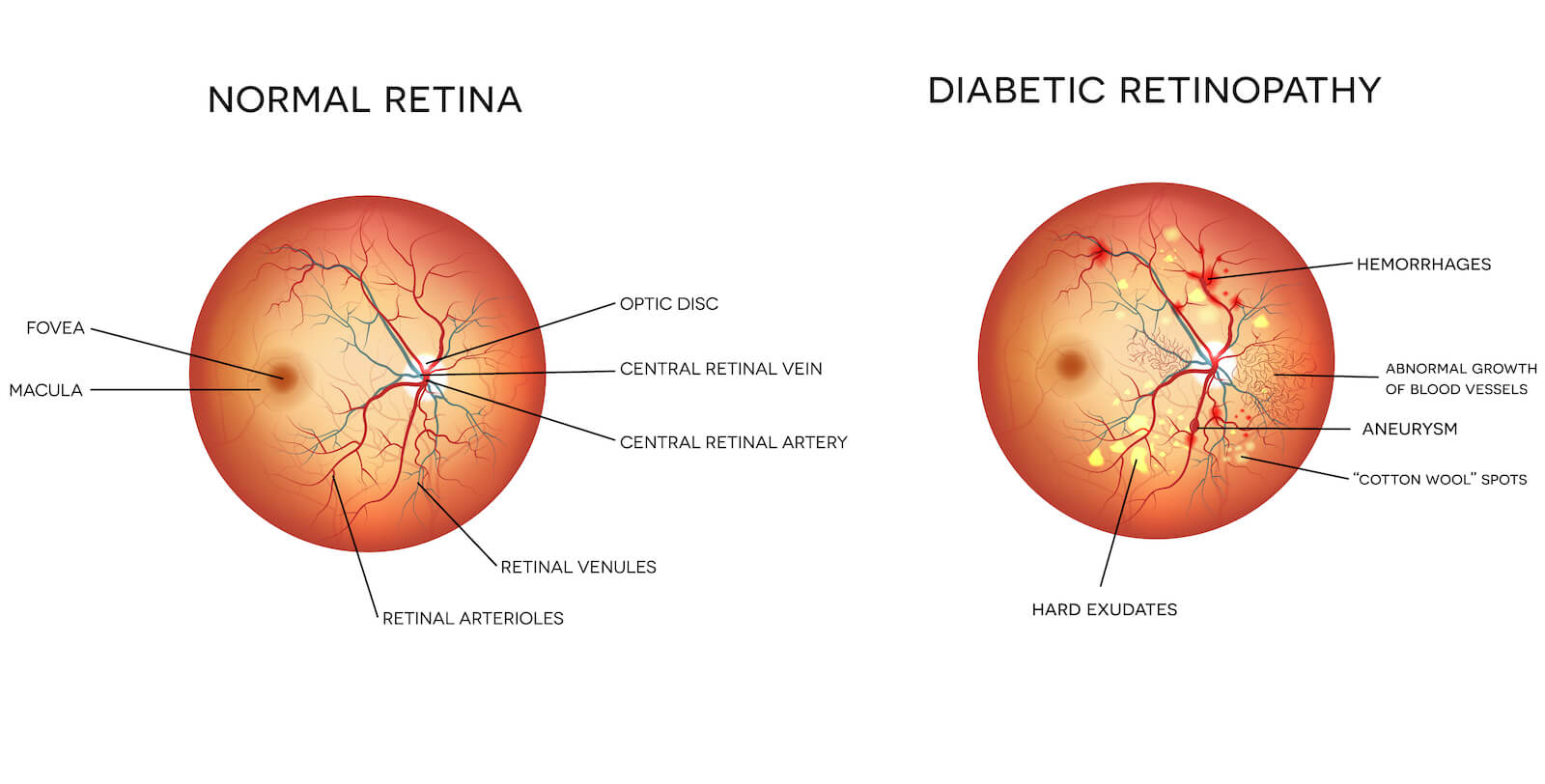Illustration of Diabetic Retinopathy