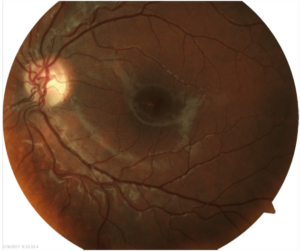 Picture of retina with retinopathy